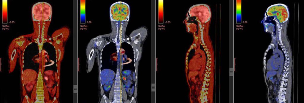 Illustration of an image from a PET scan showing the presence of an alien chestburster